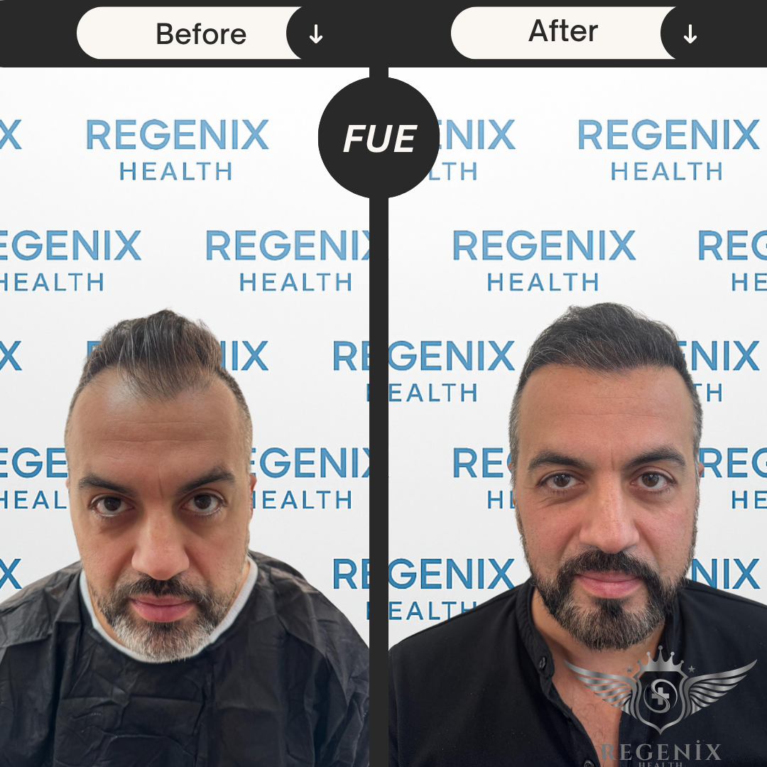 Hair Transplantation