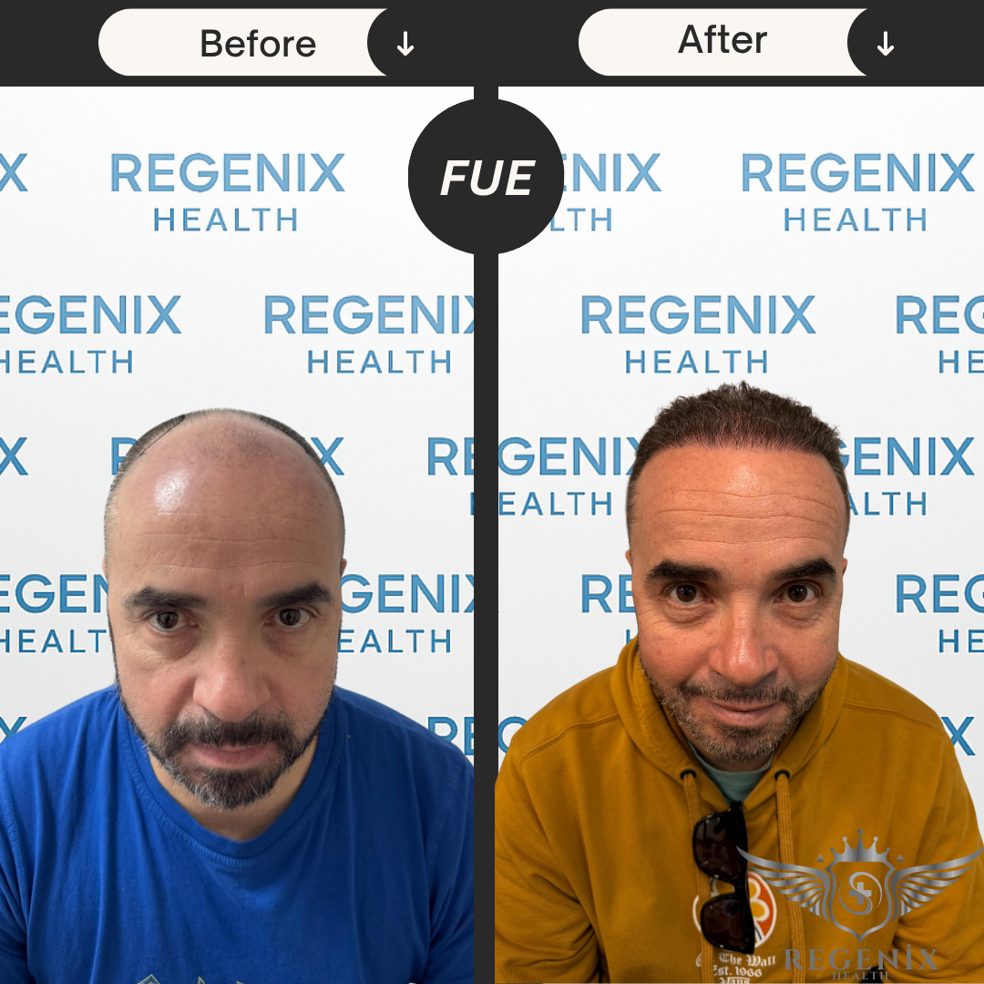 Hair Transplantation