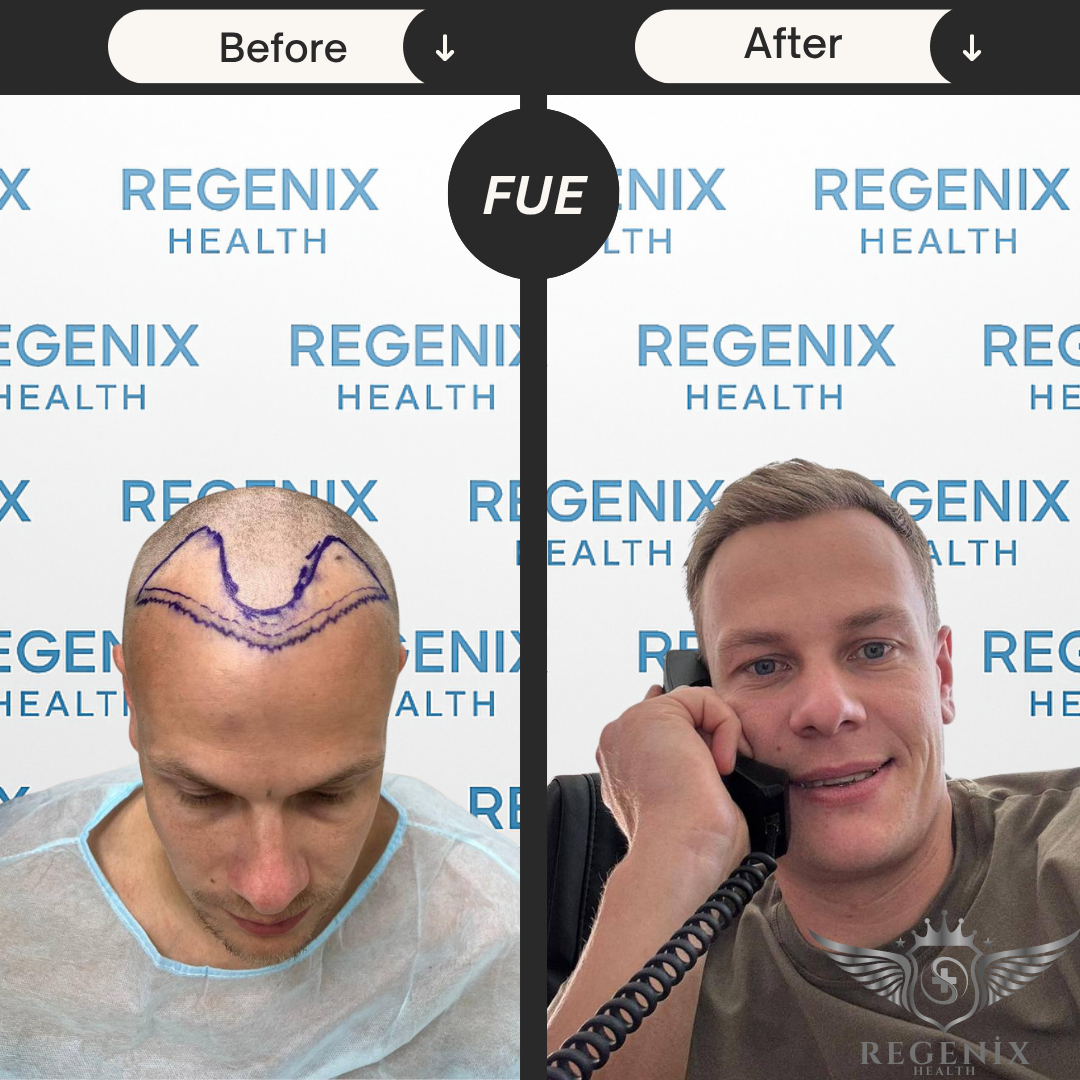 Hair Transplantation